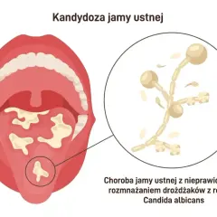 Ilustracja pokazuje jamę ustną z nalotem na języku, powiększony obraz drożdżaków Candida. Dowiedz się, jak pozbyć się candidy.