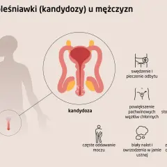 Ilustracja przedstawia objawy kandydozy u mężczyzn: pieczenie, spadek libido, powiększone węzły chłonne, ból podczas stosunku, częste oddawanie moczu, biały nalot w jamie ustnej, zaczerwienienie narządów płciowych.