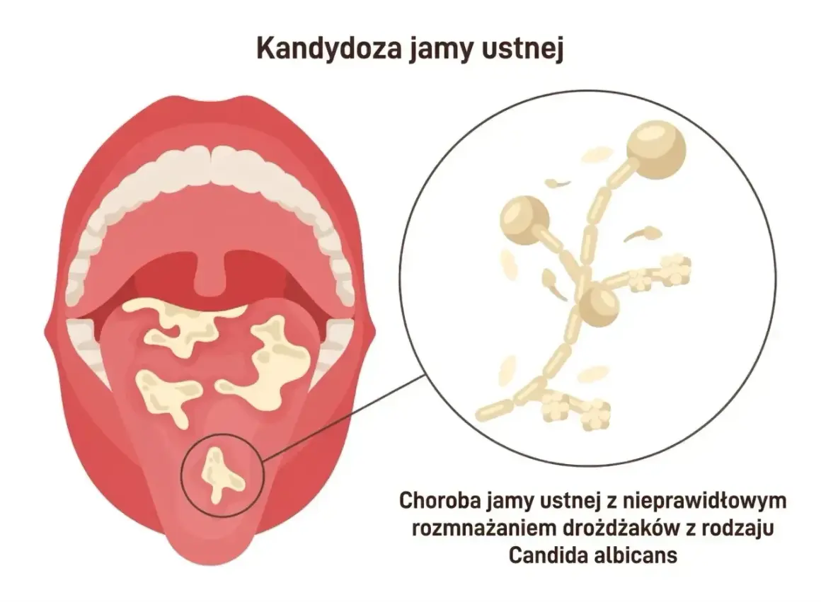 Ilustracja pokazuje jamę ustną z nalotem na języku, powiększony obraz drożdżaków Candida. Dowiedz się, jak pozbyć się candidy.