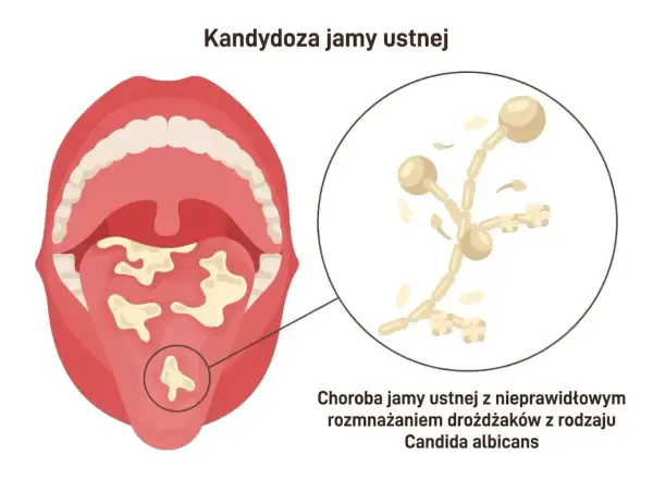 Ilustracja pokazuje jamę ustną z nalotem na języku, powiększony obraz drożdżaków Candida. Dowiedz się, jak pozbyć się candidy.